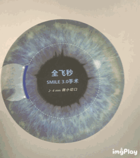 生物力学|淄博康明爱尔眼科医院：全飞秒和半飞秒的区别