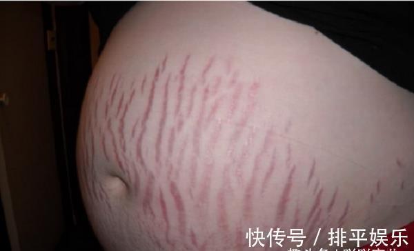 皮肤|两闺蜜同时怀孕,掀开衣服看到肚子时,对比太扎心了