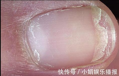 黄甲综合征|身体有问题,指甲告诉你!指甲出现9种变化,恐是疾病来袭