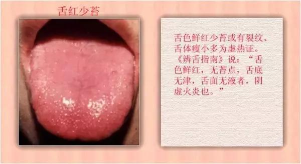 舌诊|中医医生总看舌头都在看什么九种体质+珍贵的舌诊图谱