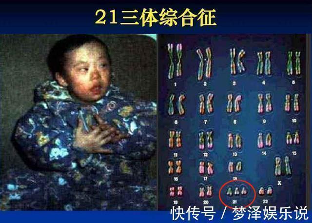 世界唐氏综合征日|世界唐氏综合征日:三类孕妇易怀“唐氏儿”,两项产检筛查很关键