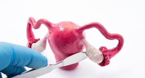 子宫|什么是子宫肌瘤?在哪种情况下才需要切掉子宫?