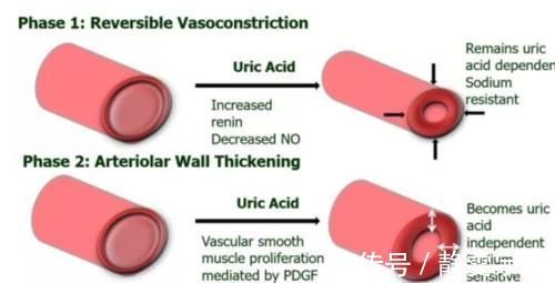 痛风性肾病|尿酸高影响肾功能吗?医生:痛风患者请做好十件事,保肾降尿酸