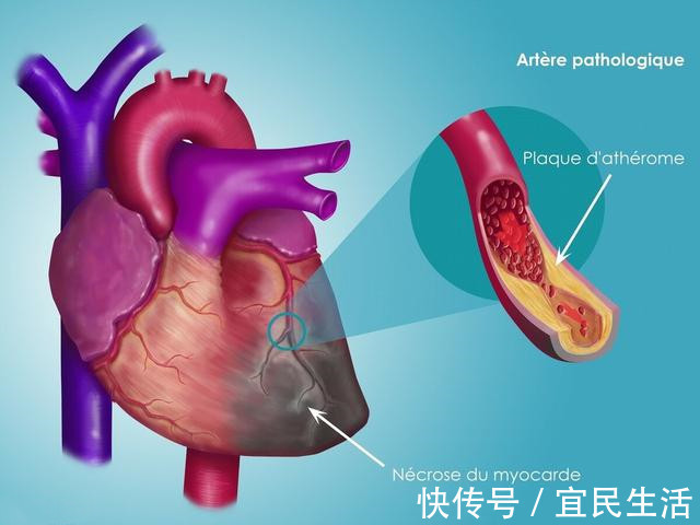 斑块|天凉了!心梗脑梗猝死多了!医生提醒这样预防心梗脑梗和猝死!