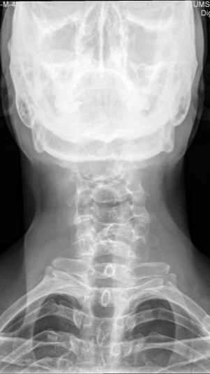 椎体|脊柱常见肿瘤及肿瘤样病变的几种影像学表现,你都见过吗?