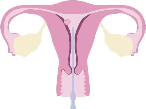 女士|促排后卵巢过度刺激,她被救护车送进急诊……|英案例