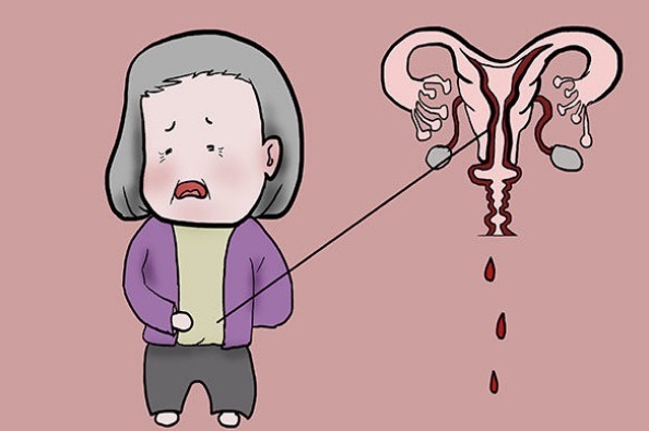 肌瘤|为何会患子宫肌瘤女性有子宫肌瘤别发愁，常吃3物，可养好子宫