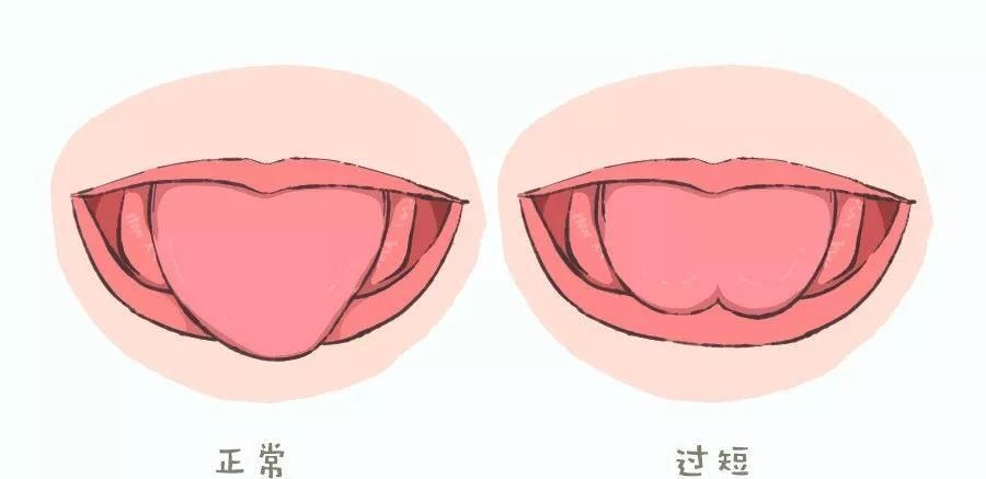 检查|孩子五岁说话不清楚,被说成是大舌头,检查时张开嘴后,医生发怒
