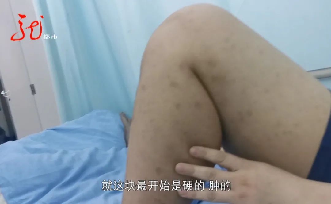 刘冰|24岁壮小伙腿部不适，没想到几天后竟陷入病危！