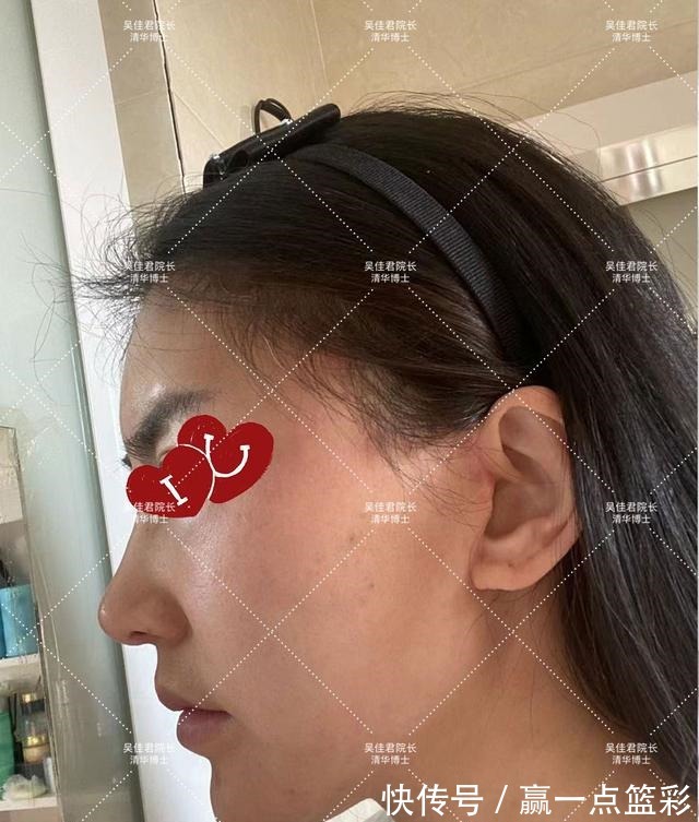 手术 40多岁大姐小拉皮手术全过程分享!