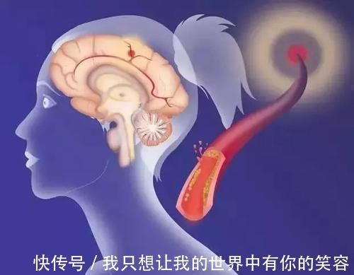 血管健康|血管堵塞不用怕,日常多食用此几物,帮你疏通血管,远离三高