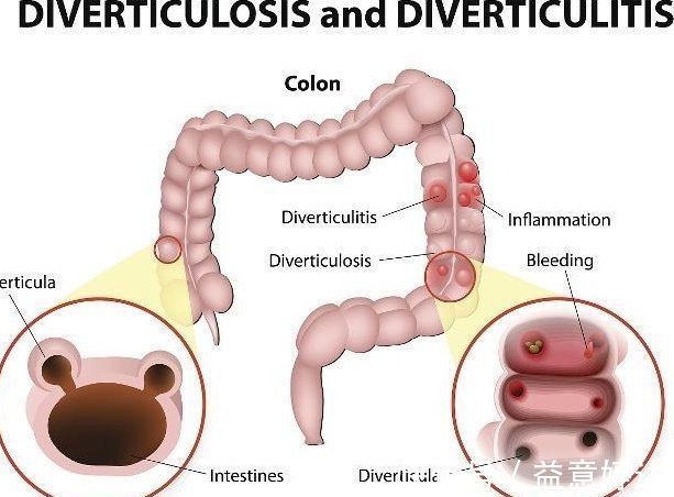 饮食习惯|为何便秘的人越来越多谨住,易给肠道“添堵”的3大食物需少碰