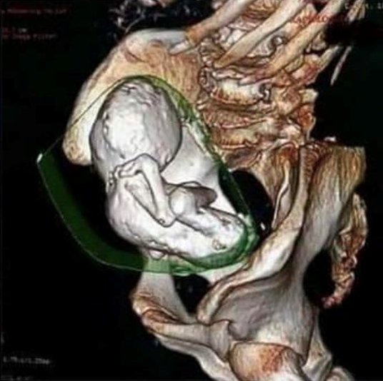 胚胎|阿尔及利亚七旬老妇肚子疼，X光发现腹中遗留35年已石化婴儿