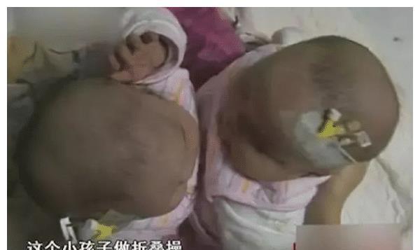 杨伟|还记得我国首例“坐骨连体”双胞胎女婴吗？多年后，她们化茧成蝶