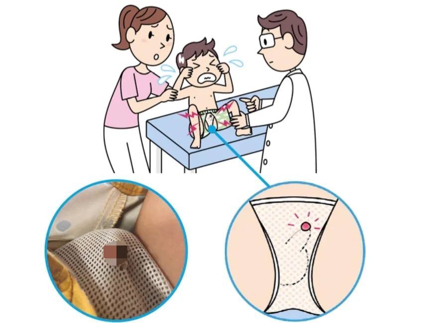 男童|这种泳裤千万别穿 已经有不少小孩的小鸡鸡因它受伤