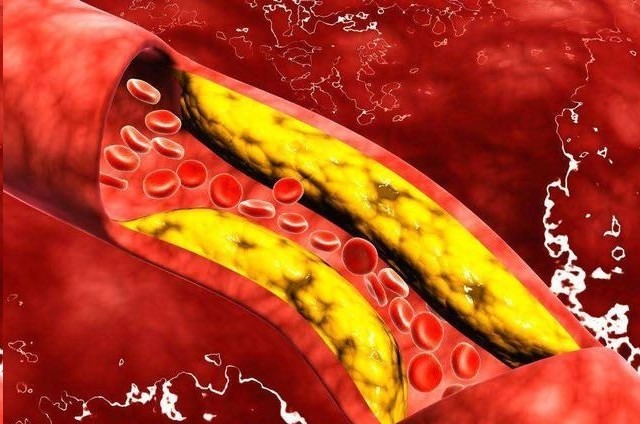 玉米须|脑梗的“救命恩人”来了,家中常备,血管不堵、血脂稳稳的