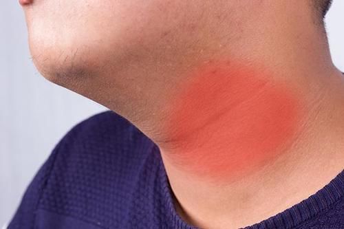 甲状腺结节不严重,不用护理?专家辟谣:遇到3种情况需定期复查