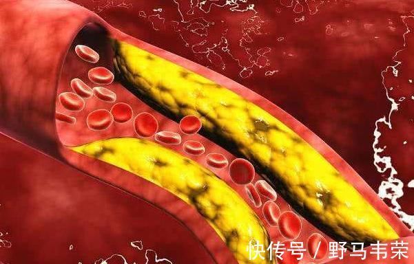 升高|三个信号出现在腿上，也许是因为血脂升高，尽量不要忽视！
