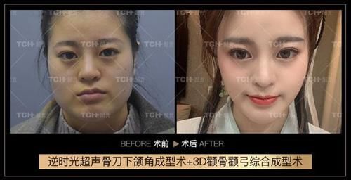 案例分享丨国字脸下颌角+颧骨颧弓手术案例分析