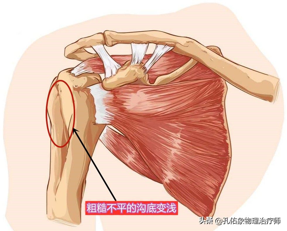 肱二头肌|出现肩膀疼痛、活动困难就是肩周炎吗？医生辟谣，带您了解肩痛