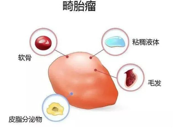 生殖细胞|“畸胎瘤？”别怕，它没有听起来那么恐怖！