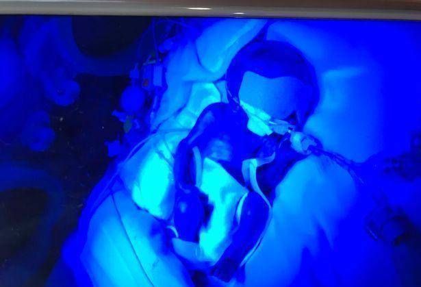 阿乐|英国妇女在怀孕21周时生下一个孩子宝宝是透明的,可以看到体内的血液流动