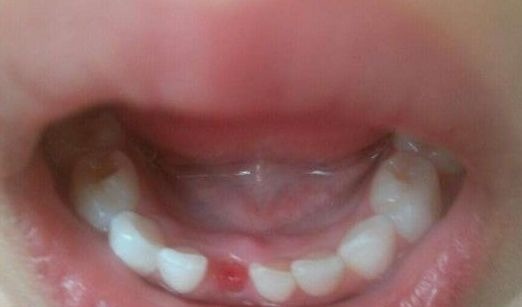 女孩|孩子几岁开始换牙,属于发育正常?男孩和女孩有什么区别?