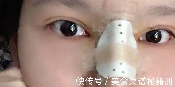 自然风格 隆鼻术后假体穿透鼻尖,这也太吓人了!