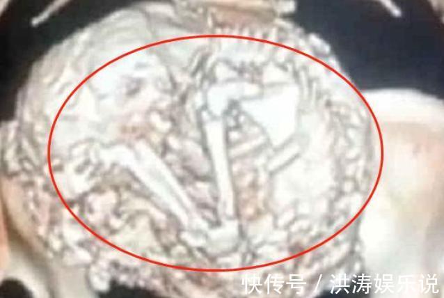 孕妇|老人91岁才发现怀孕,胎儿在肚里已待61年,网友地表最强钉子户