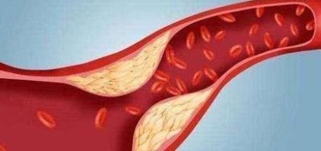 门栓|此物天然的“溶栓剂”,喝水时加点,血液不堵,脑梗不来