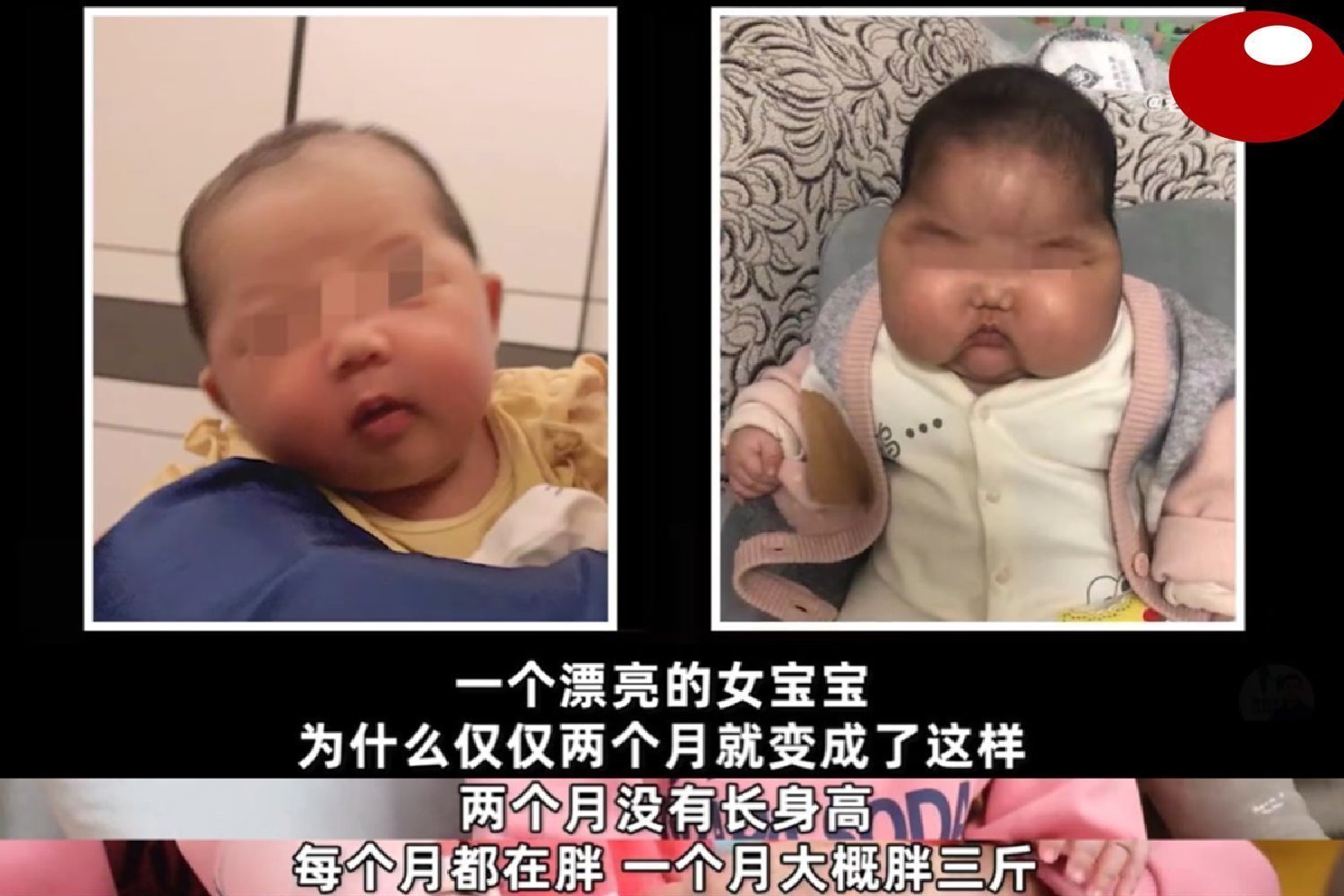 抑菌|“大头娃娃”再现,抑菌霜激素超标,致5个月女婴疯狂长胖长毛