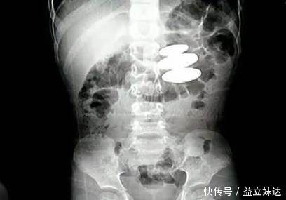 消化道|家长们注意了！这些东西如果被孩子误吞！附急救方法