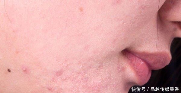 糟糕|肝脏毒素多,有这3个表现,按摩能帮你排毒,3个穴位要多按摩