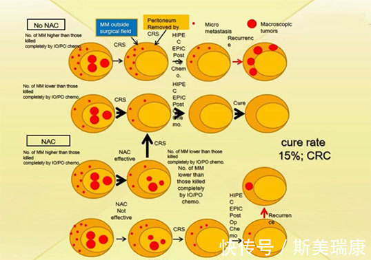 癌细胞|日本米村丰胃癌患者生存曲线：五年生存率达到47%！
