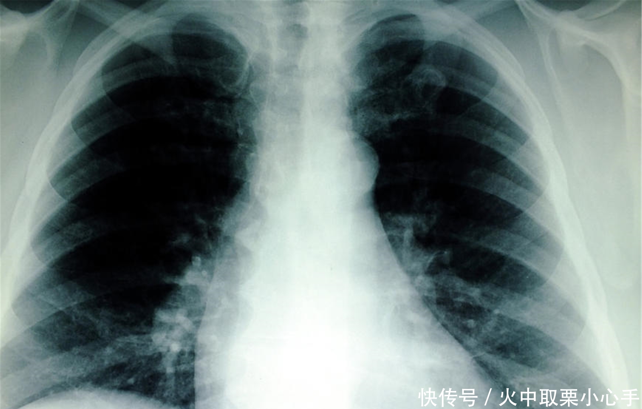 肺病大多是“熏”出来的,做好这4件事,肺慢慢变好!