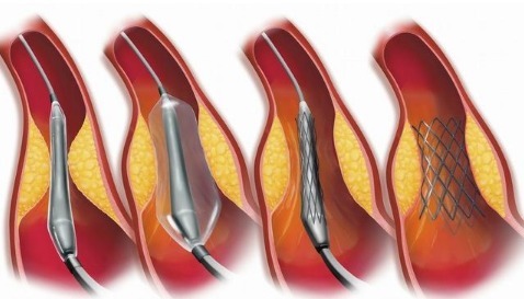 动脉血管|3个人就有1个颈动脉斑块！如何预防和治疗医生说的清清楚楚