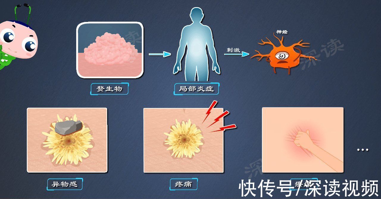 尖锐湿疣|明明没出轨，为啥染上尖锐湿疣？有哪些你不知道的事会招惹HPV？