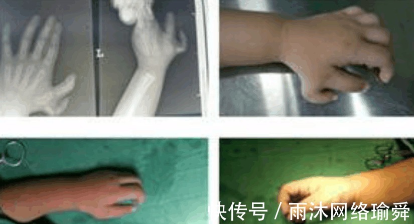 医生|孩子出生就有25根指头, 医生看到宝妈的手, 明白了原因