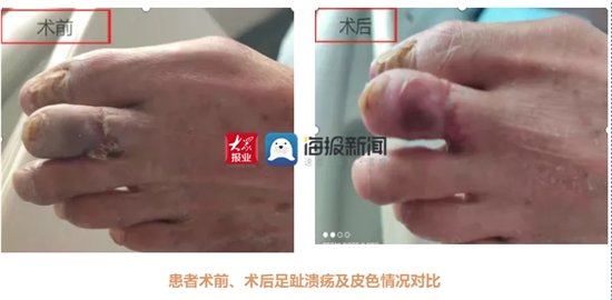 微创开通血管手到病除|万杰医院:七旬大伯腿痛难忍夜不能寐,介入微创开通血管手到病除