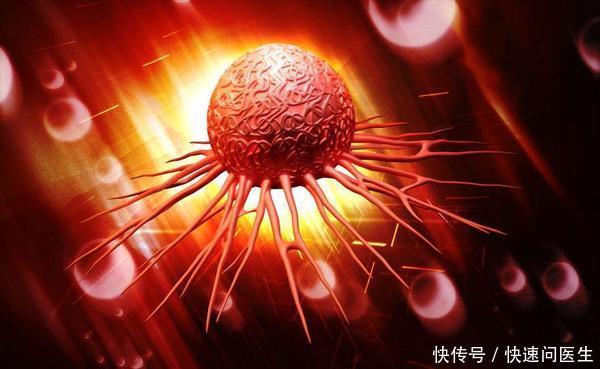 胰腺癌被称为“癌王”,早期发现胰腺癌,对治疗有重大意义