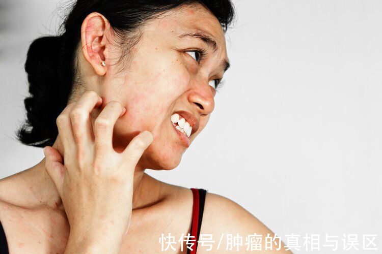 皮肤瘙痒|不是皮肤病，而是癌症预警？皮肤出现3个异样，及时做检查为妙