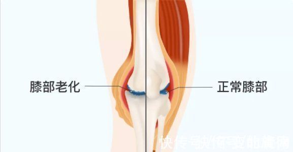 关节软骨|它比跑步更伤膝盖,如何“延长膝盖寿命”,骨科医生这样说