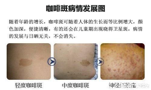 胎记|胎记需要治疗吗?医生告诉你,这些胎记不治疗真的不行!