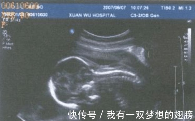 准妈妈|B超单上的这4个字是什么意思 别担心, 别人羡慕还来不及呢!