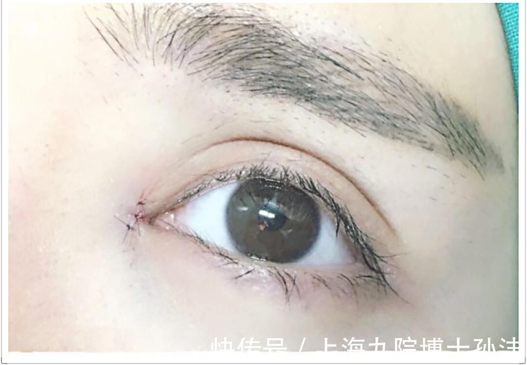双眼皮手术 双眼皮手术后,眼型看起来圆了真的好看吗?