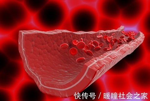 特征|血脂高的人,面部有3个特征,若都没有,血管还算健康