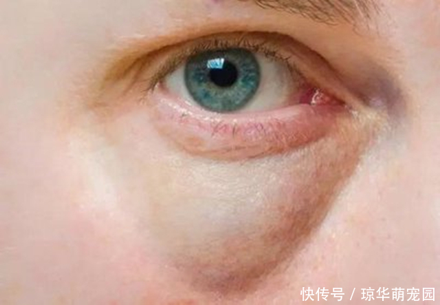 怎样祛眼袋？中医还真有办法，支你3招，一招比一招强，女性要看