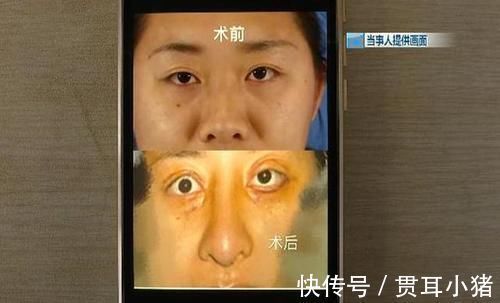 眼角膜 女子花60000整容,术后却整成“凹陷鼻”,找其理论主刀医生闭门不见