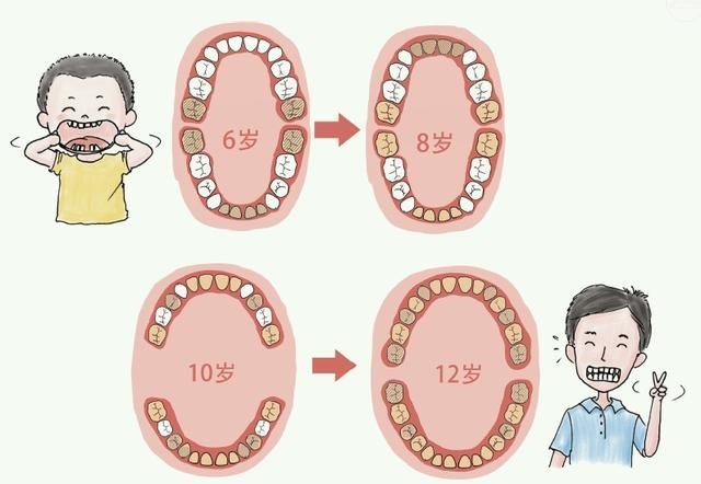 恒牙|6-12岁孩子换牙期，父母困惑可不少：双排牙、锯齿状、缝隙大等