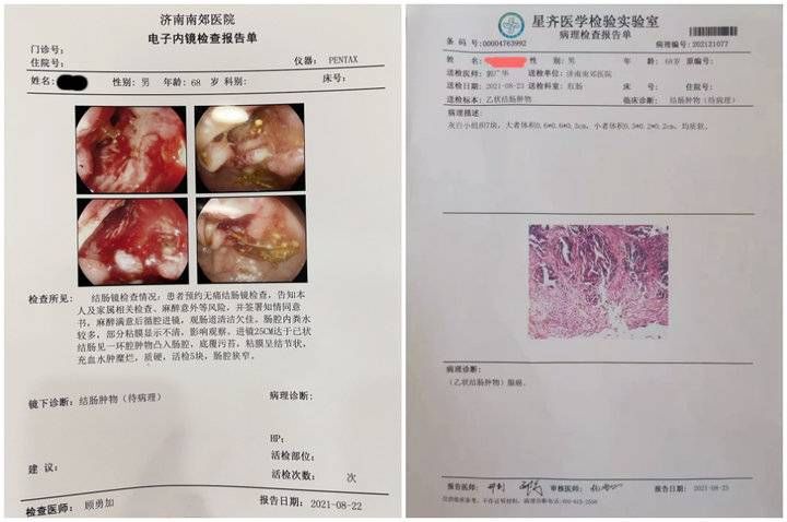 腺瘤息肉|毫无症状镜检出结肠腺癌,40岁以上人群尤其需要注意
